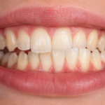 Crossbite