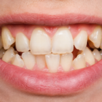 Crowded Teeth