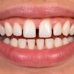 Gaps Between Teeth