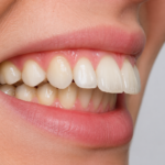 Protruding Teeth (1)