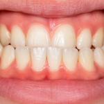 Underbite
