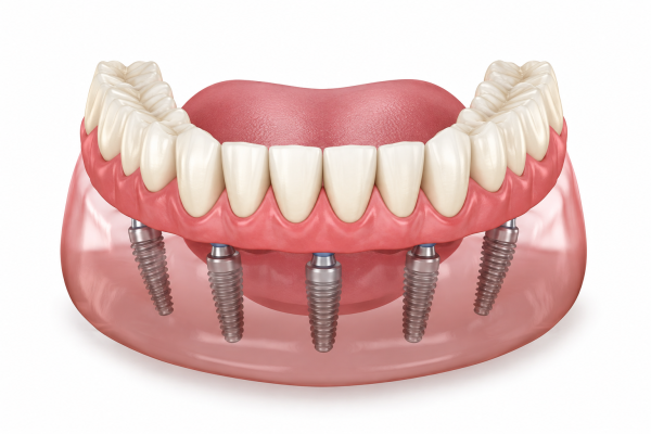 Full-Arch Dental Implants