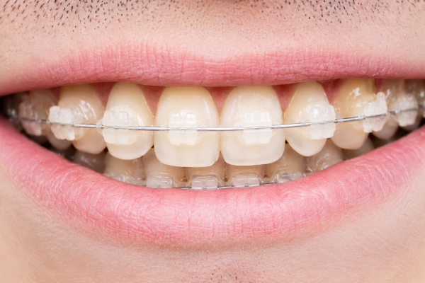 ceramic braces