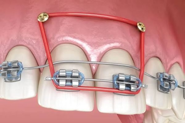 complex braces