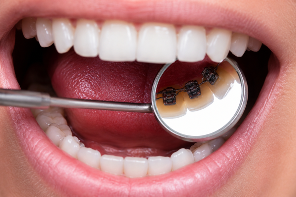 lengual braces