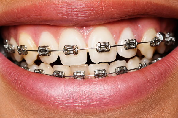 metal braces