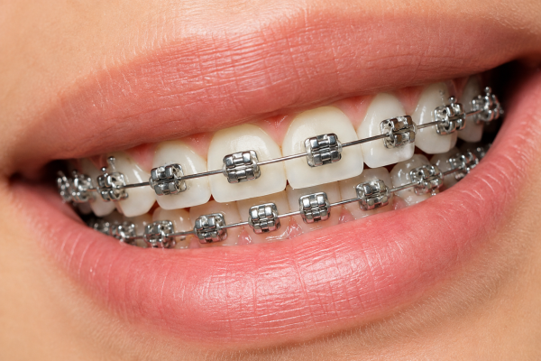 self legating braces